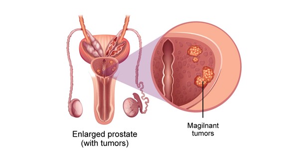 Figure 1 Malignant tumor in the prostate area